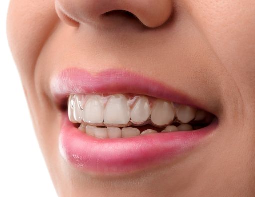 Beda dengan Kawat Gigi, Ini Kelebihan Pakai Behel Transparan