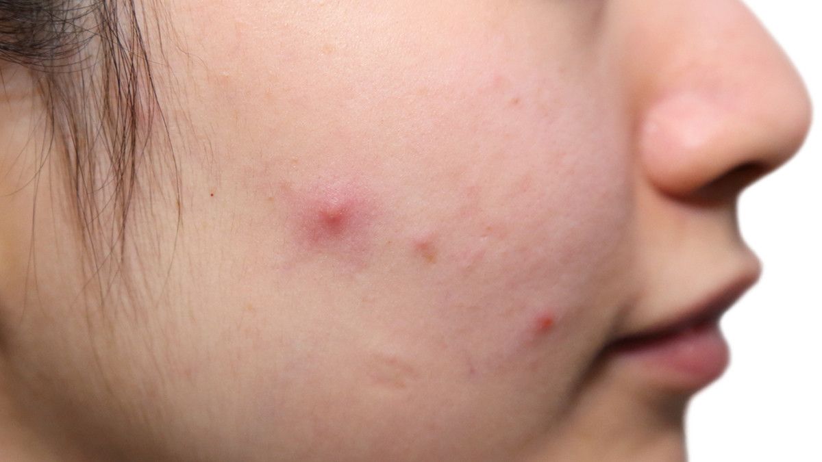 Mengatasi Jerawat dengan Aseton, Aman atau Tidak?