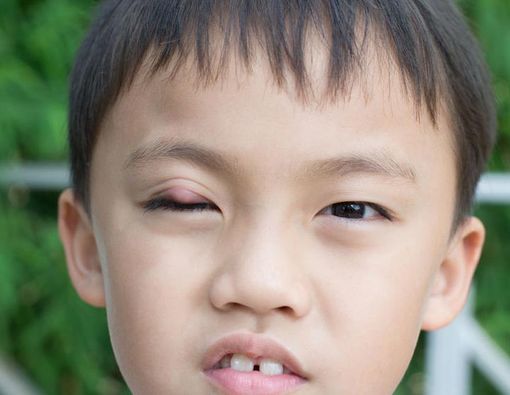 Apa Penyebab Anak Sering Bisulan?