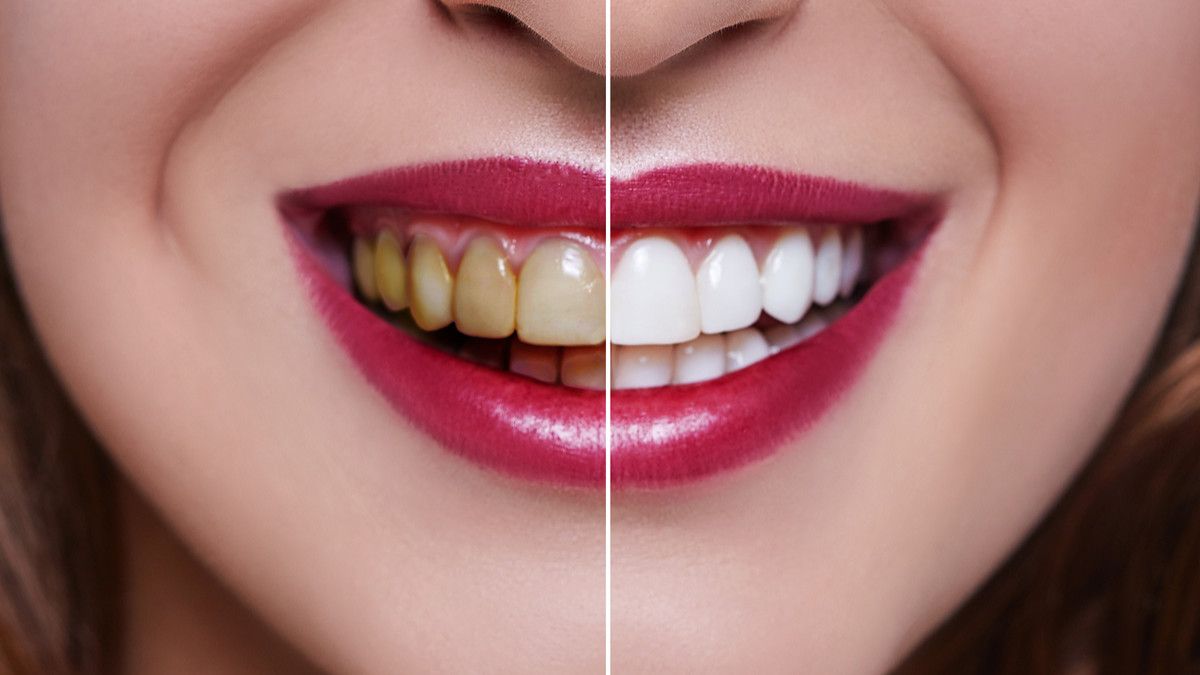 4 Mitos Tentang Veneer Gigi yang Harus Diluruskan