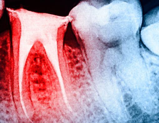 Kenali Lebih Jauh tentang Infeksi Saluran Akar sebelum Makin Parah