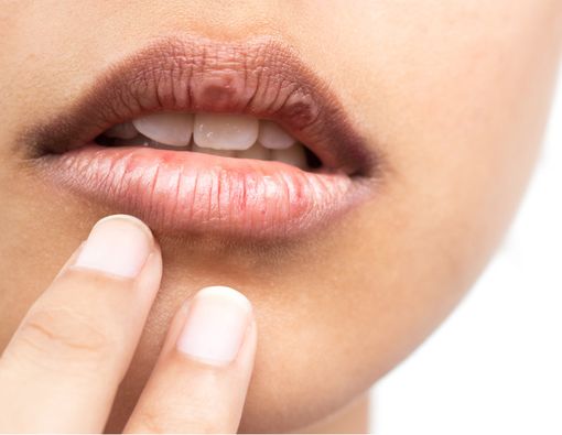 Hati-hati, Bibir Kering Memicu Sariawan