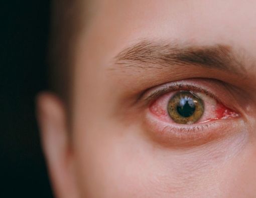 Mata Merah Setelah Menangis, Ini Alasan Medisnya!