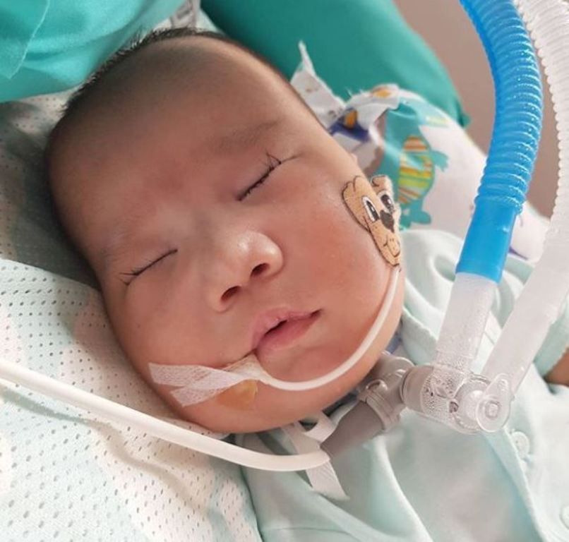 Mengenal Trisomi 13 yang Diderita Adam Fabumi