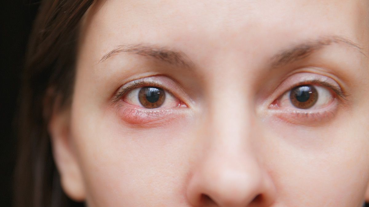 Mata Sering Bintitan Akibat Sering Konsumsi Makanan Berlemak?