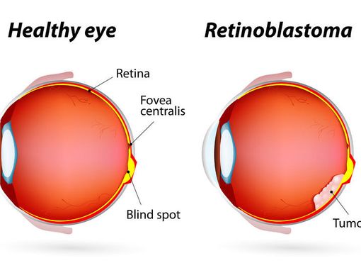 Retinoblastoma Timbulkan Kebutaan Permanen Pada Anak