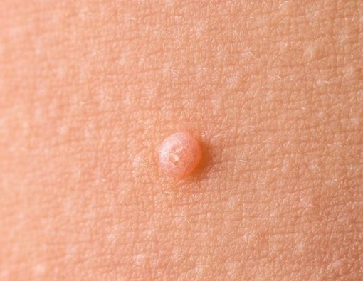Mengenal Molluscum Contagiosum, Benjolan Mirip Jerawat pada Bayi