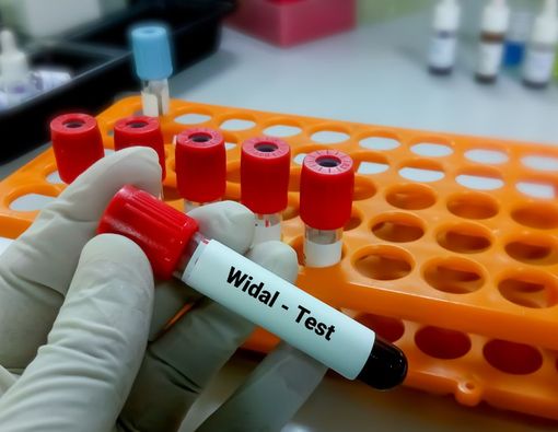 Tes Widal, Pemeriksaan untuk Diagnosis Penyakit Tipes