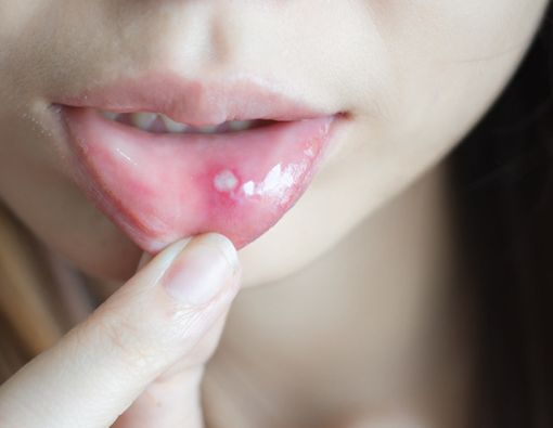 Stomatitis pada Mulut, Apa Itu?