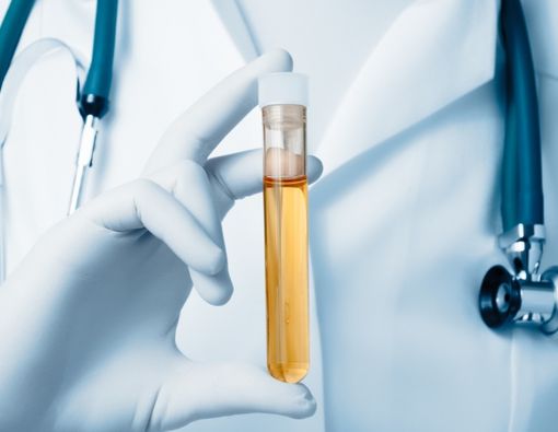 Warna Urine Dapat Menandakan Masalah Ginjal