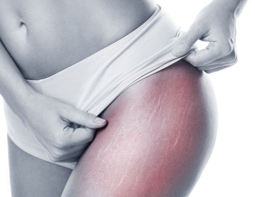 4 Gejala Stretch Mark di Kulit