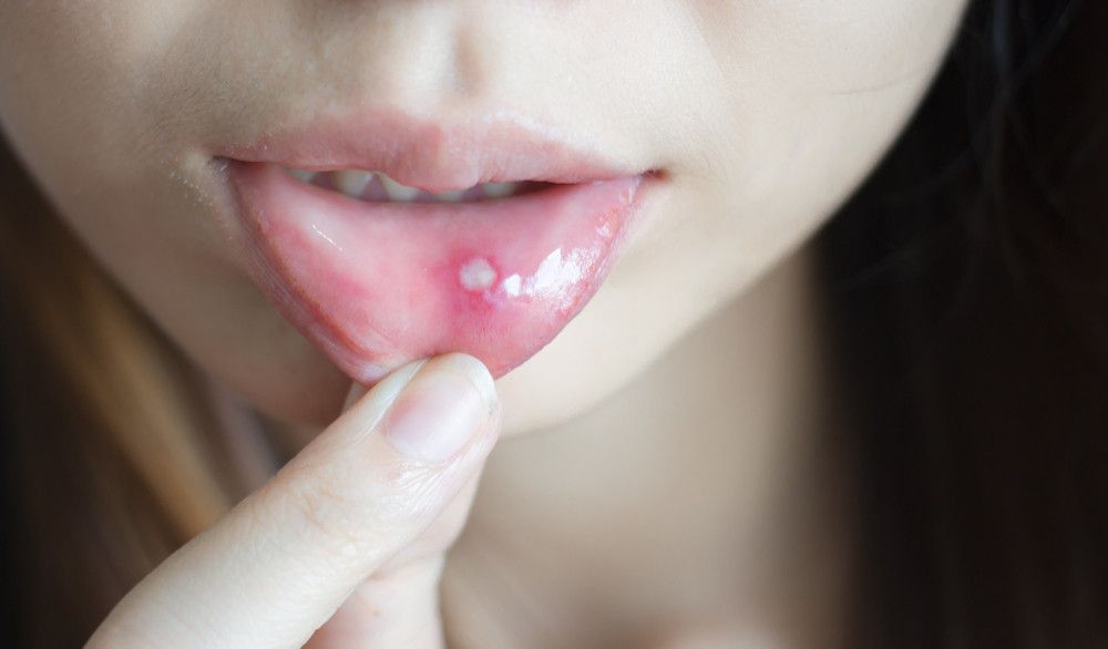 Stomatitis pada Mulut, Apa Itu?