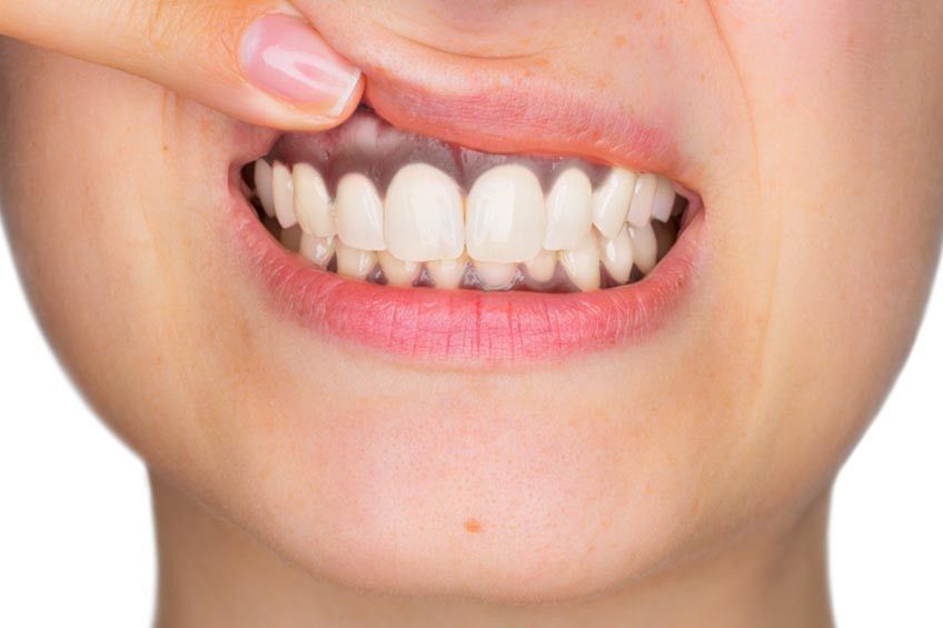 Inilah Penyebab Gusi Hitam yang Kamu Perlu Tahu