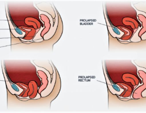Prolaps Organ Panggul, Masalah Setelah Melahirkan