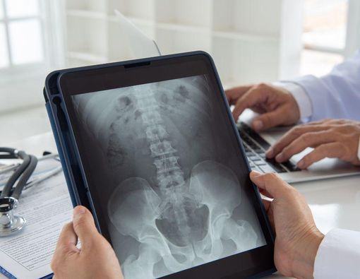 Caudal Regression Syndrome