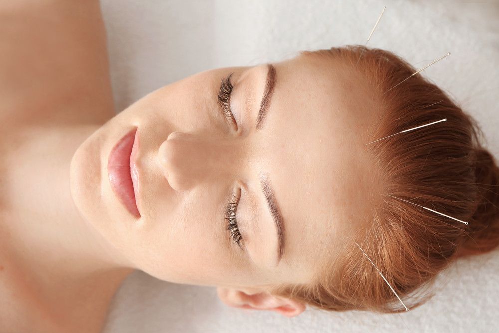 Terapi Akupunktur sebagai Cara Mengatasi Sakit Kepala, Efektifkah?