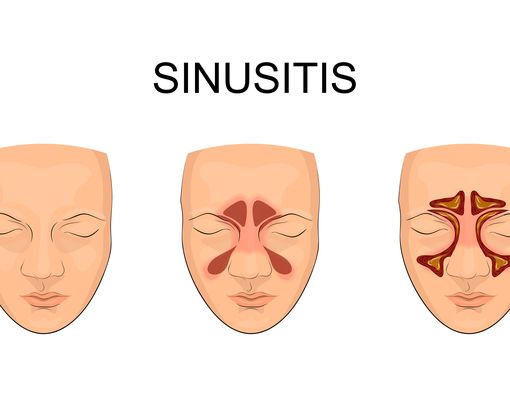 Haruskah Dioperasi Jika Punya Sinusitis?