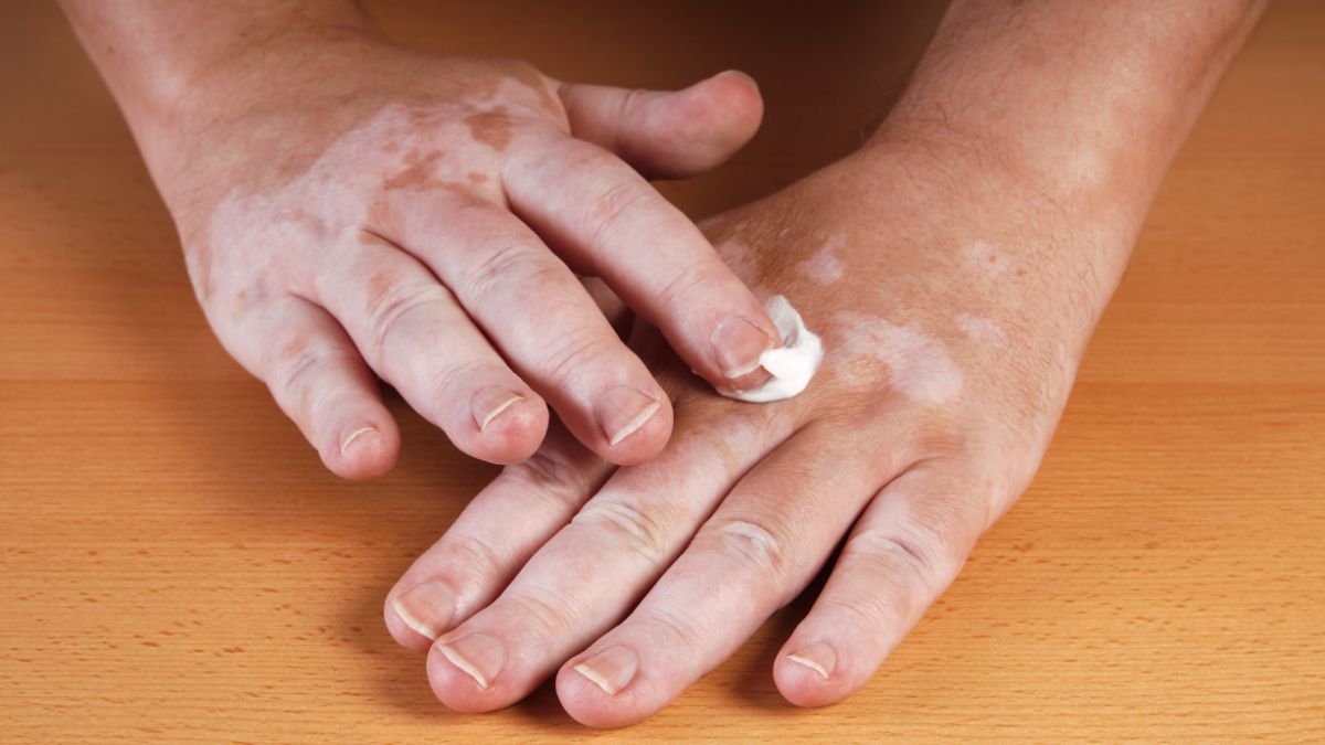 Muncul Bercak Putih Vitiligo? Ini 4 Obat Untuk Kurangi Gejalanya
