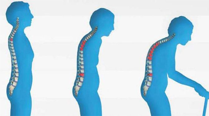 Yuk, Berolahraga untuk Kekuatan Tulangmu