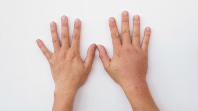 Penyebab Jari Bengkak yang Jarang Diketahui