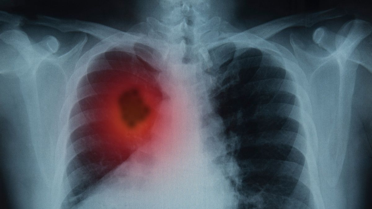 Tumor di Paru Pertanda Kanker Paru, Benarkah?