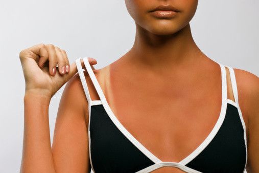 Obat Baru untuk Sunburn