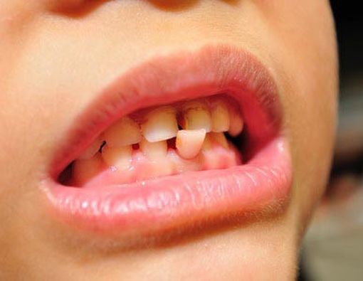 Mengapa Gigi Bisa Goyang?