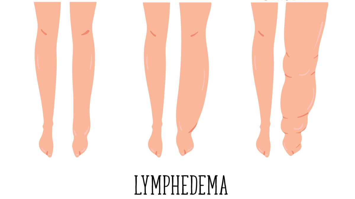 Kenali Limfadema, Gangguan Kesehatan Pemicu Bagian Tubuh Bengkak
