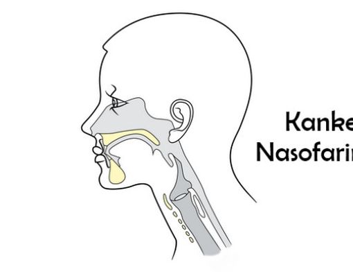 Mengenal Kanker Nasofaring Lebih Jauh