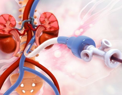 Tips Tidur Tetap Nyaman untuk Orang dengan Stent Ginjal