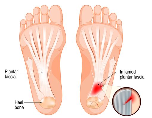 Pengobatan plantar fasciitis deals