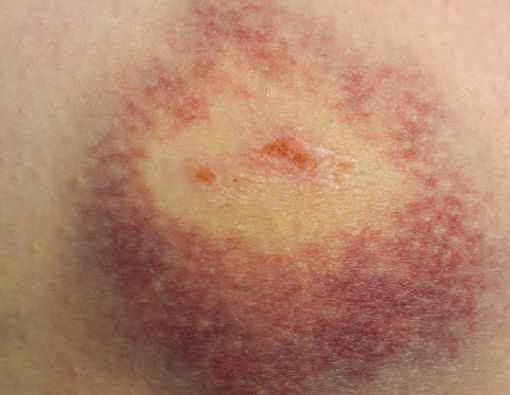 ITP (Purpura Trombositopenia Idiopatik)