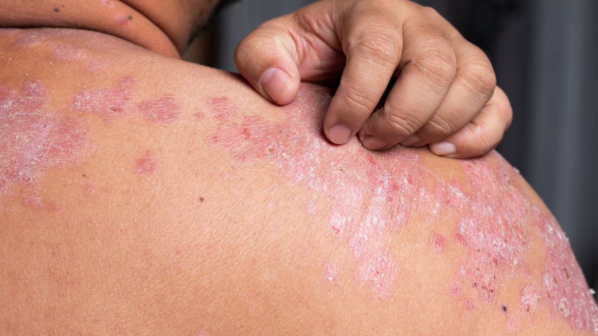 Cara Mengatasi Darah Manis atau Prurigo