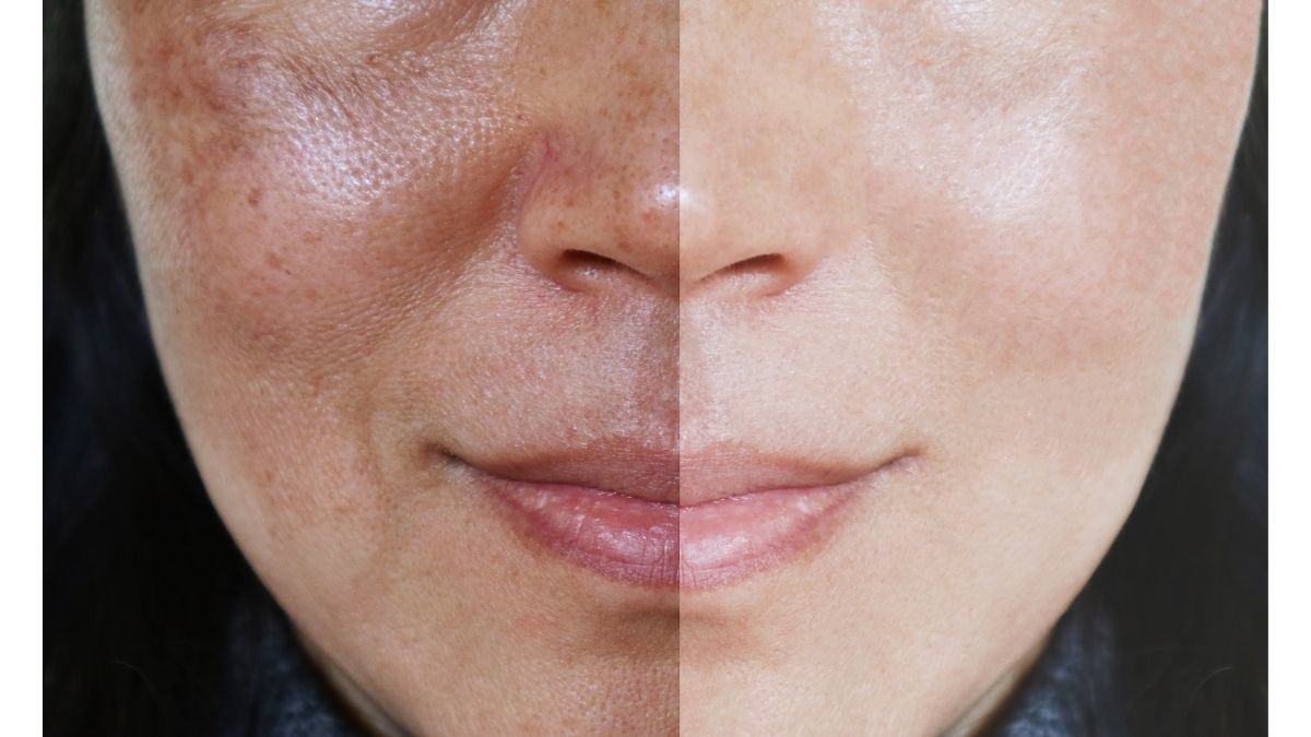 Vitamin Untuk Mengatasi Bercak Melasma