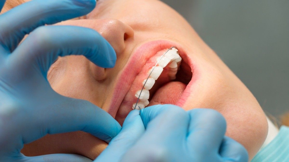 Waspadai Jasa Pemasangan Behel Gigi di Situs Jejaring Sosial
