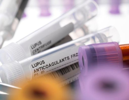 Beragam Cara Efektif Mencegah Lupus Kembali Kambuh