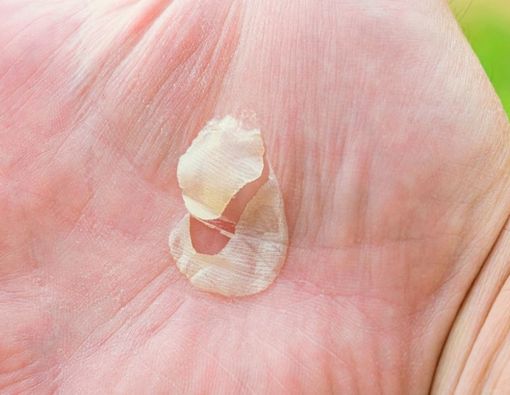 Penyebab Kulit Telapak Tangan Mengelupas dan Cara Atasinya