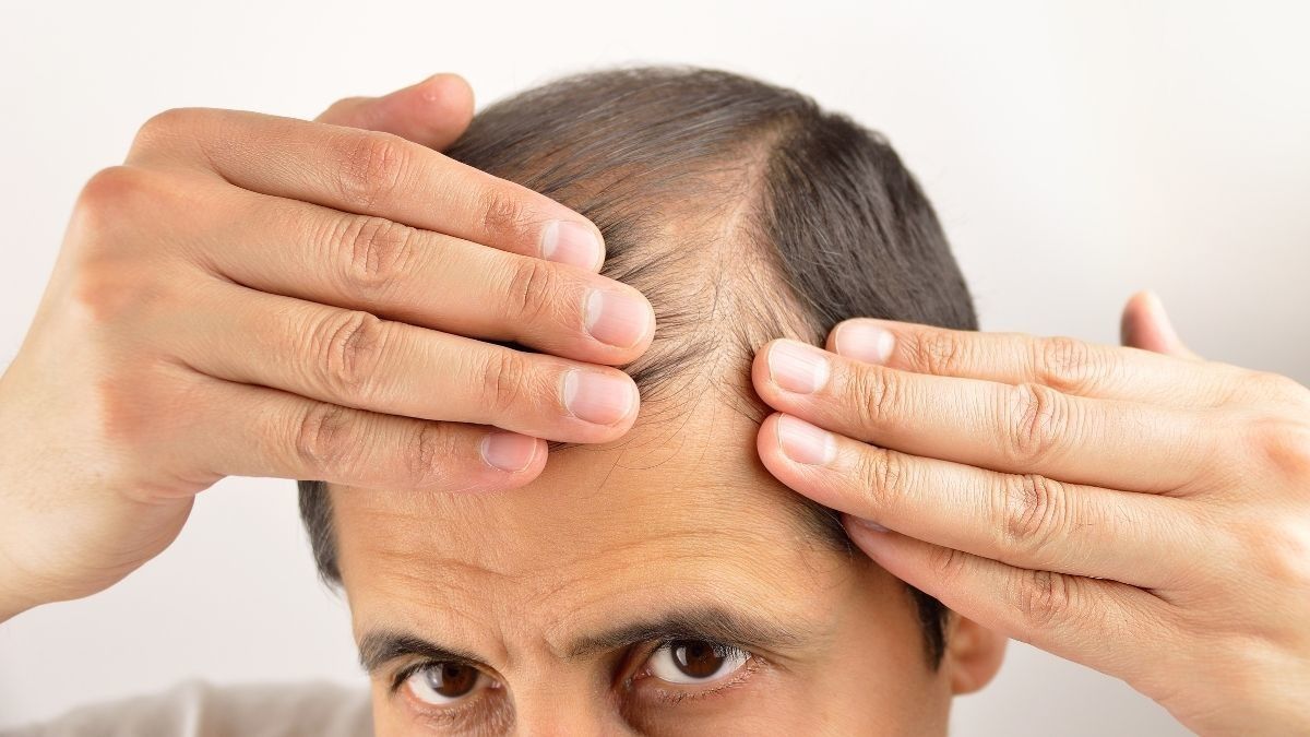 Rambut Pria Bisa Rontok Akibat Masturbasi atau Onani, Benarkah?