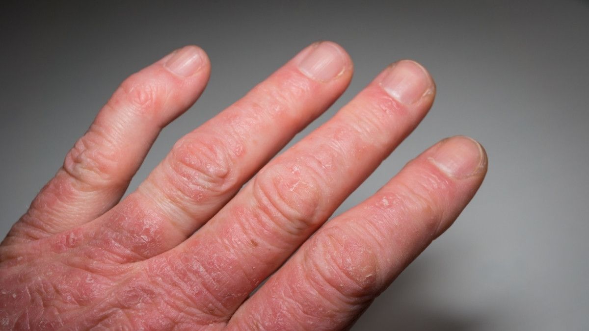Benarkah Kondisi Psoriatic Arthritis Meningkatkan Risiko Terkena Kanker?