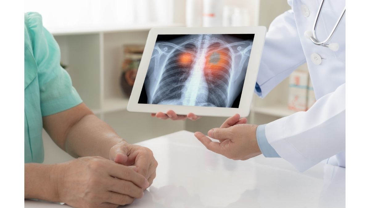 Alasan Transplantasi Paru Pasien Kanker Jarang Dilakukan