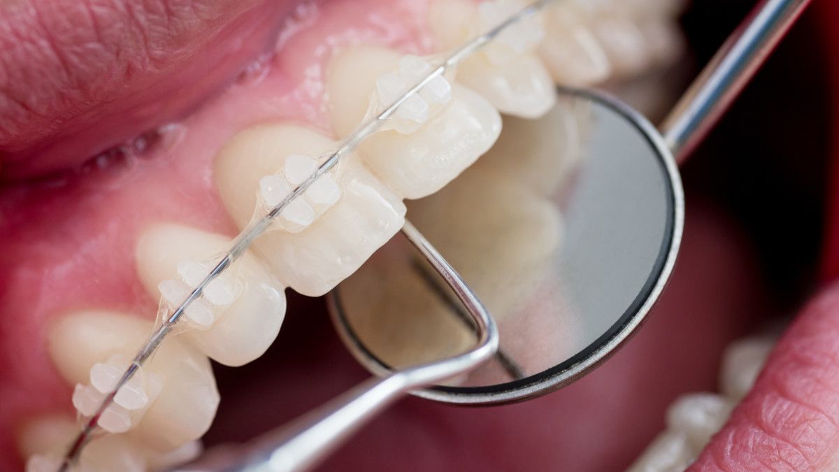 Pakai Behel Bisa Bikin Gigi Kuning, Ini Alasannya