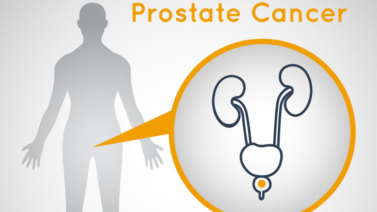 9 Cara Tepat Hambat Kanker Prostat