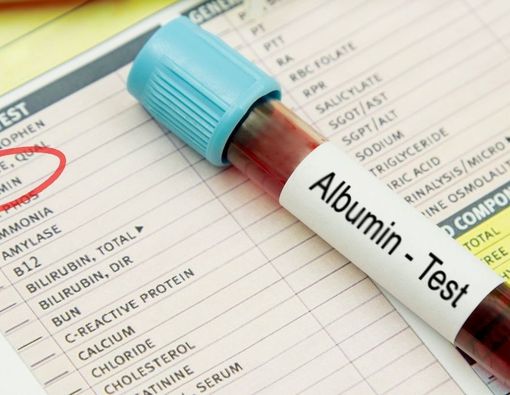 Mengenal Pemeriksaan Albumin dan Prosedurnya