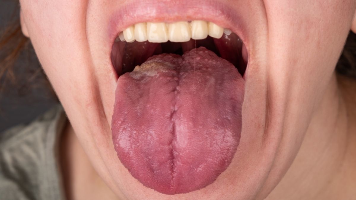 Faktor Risiko yang Menyebabkan Kanker Mulut