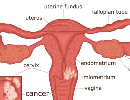 Lindungi Diri dari Kanker Serviks, Lakukan Ini