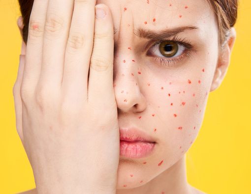 Mungkinkah Terserang Cacar Air Dua Kali?