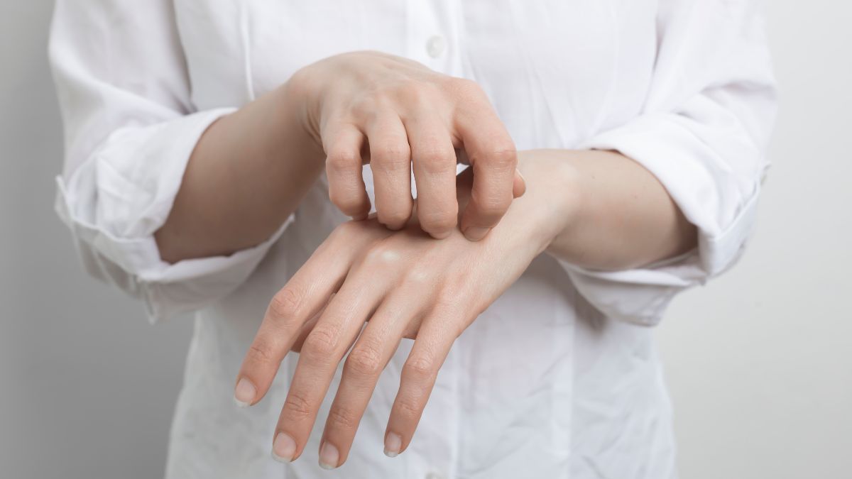 Mirip Eksim, Berikut 5 Gejala Scabies yang Perlu Diwaspadai