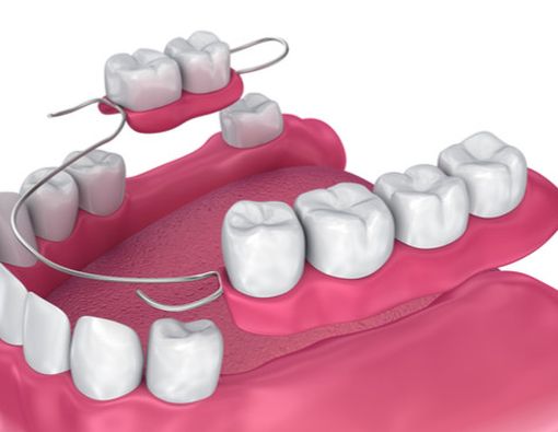 Waktu yang Tepat untuk Mengganti Gigi Palsu