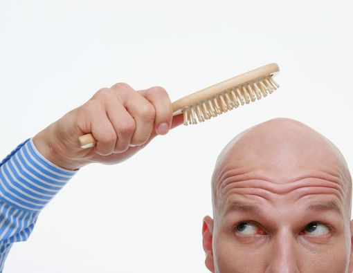 Awas, Kebotakan Dapat Terjadi karena Faktor Keturunan