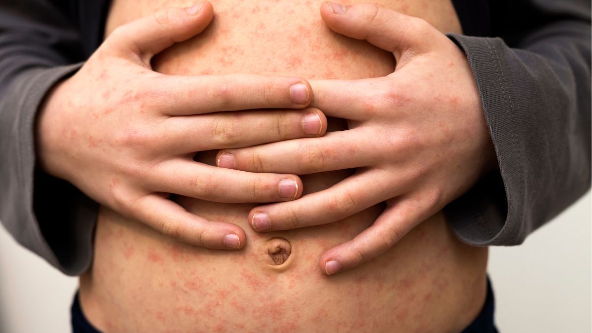 9 Cara Mengobati Penyakit Campak